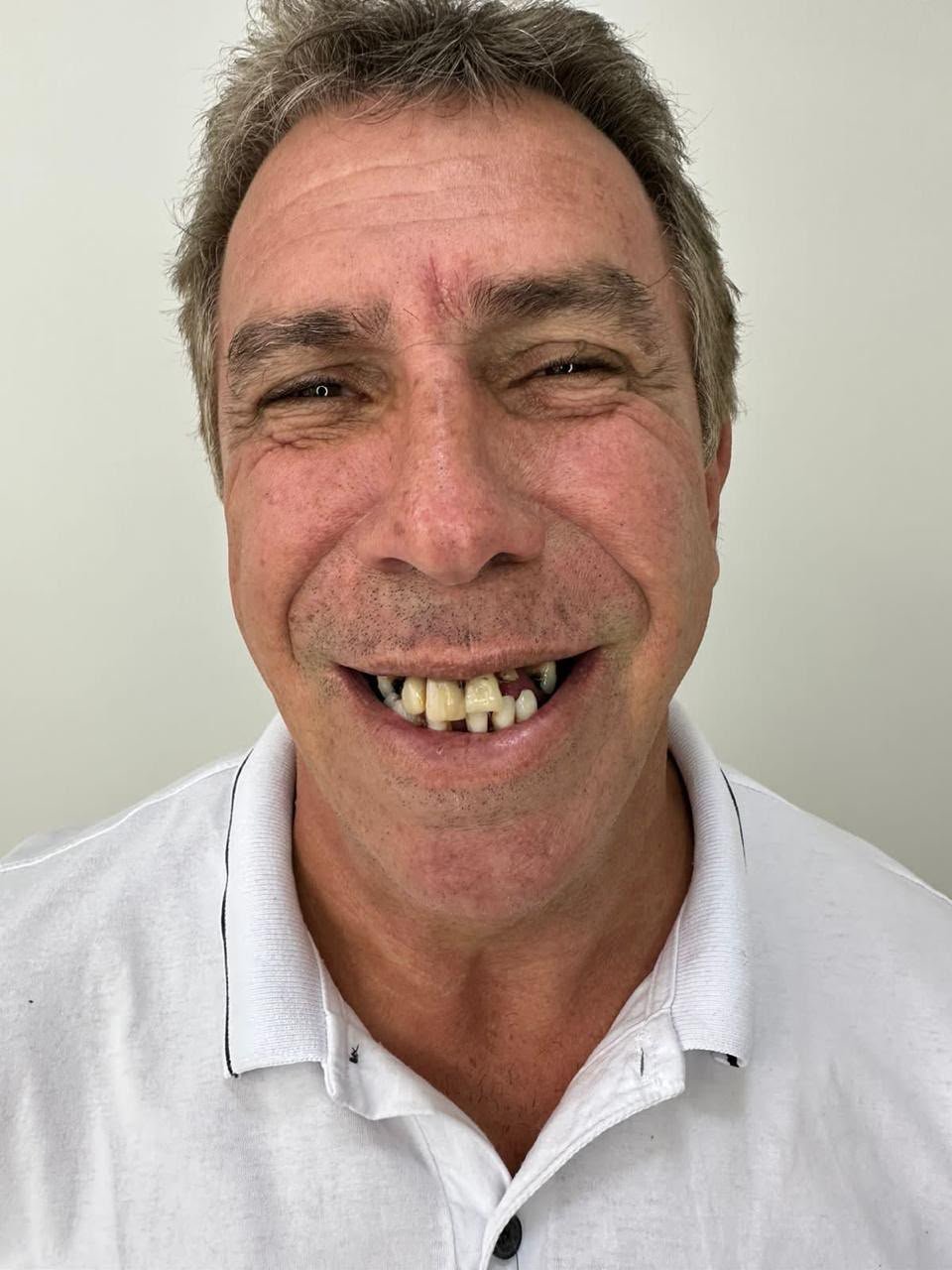 Antes - Implante Dentário