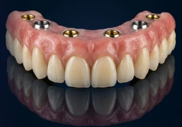 Prótese Protocolo sobre implantes